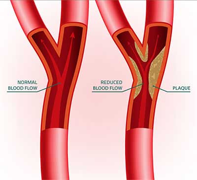 Arterial Plaque Buildup and Removal in Toluca Lake, CA