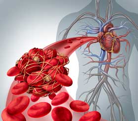 Blood Clot Treatment in Los Angeles, CA